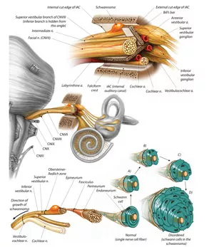 medical illustration of a Vestibular Schwannoma