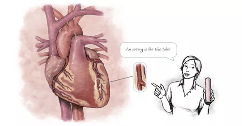 Illustration comparing heart artery to tube