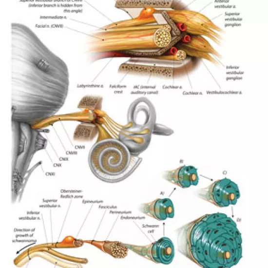 medical illustration of a Vestibular Schwannoma